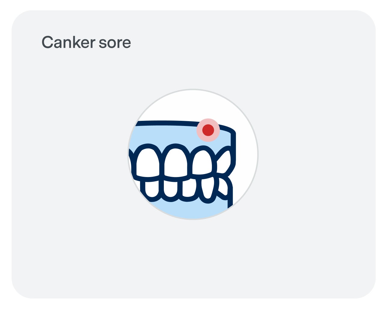 Illustration of teeth with a red sore on the upper jaw gum, indicating a canker sore.