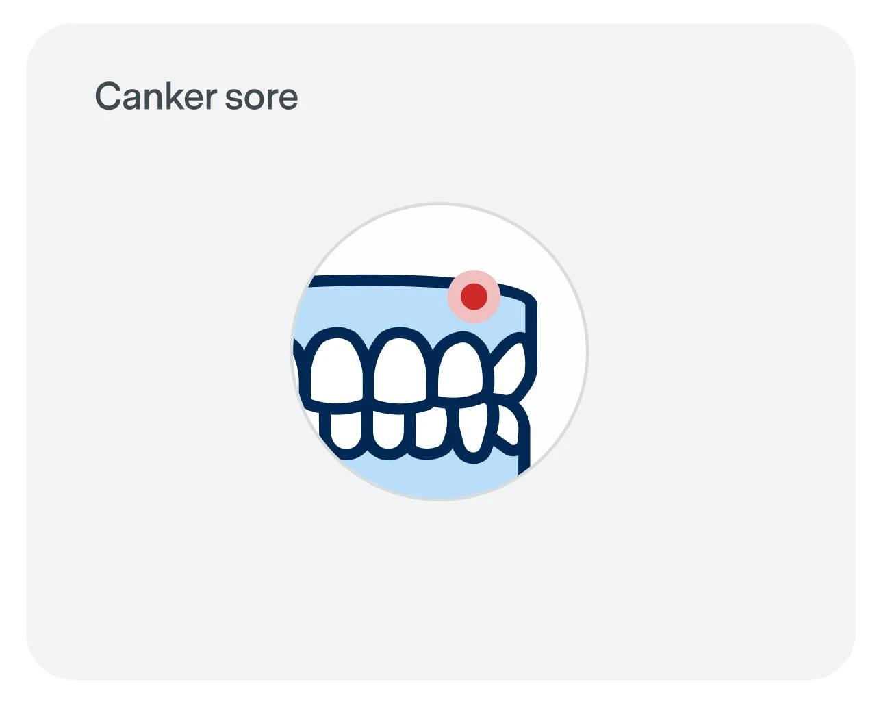 Illustration of teeth with a red sore on the upper jaw gum, indicating a canker sore.