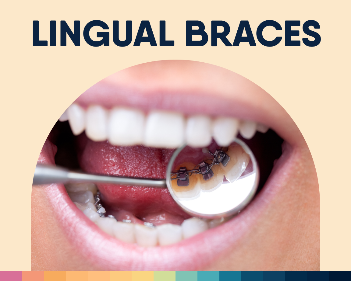 Mouth open showing lingual braces with mirror, text LINGUAL BRACES above.