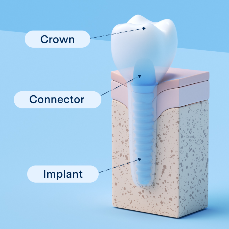 3D diagram of dental implant parts with labels Crown, Connector, Implant on a jaw cross-section against blue.