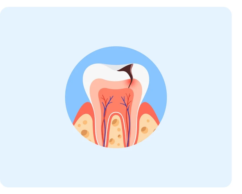 Illustration of a tooth with severe tooth decay embedded in gum tissue, displayed in a circular frame with light blue background.