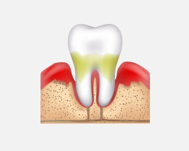an image of tooth and gums infected with a moderate stage of gingivitis.