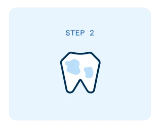 The second step in the teeth filling process is the removal of decay from the tooth.