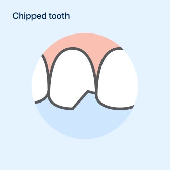 Simple illustration of a chipped tooth, highlighting the damage to the tooth’s edge. The image is labeled “Chipped tooth” and is designed to visually explain dental issues related to tooth chipping.