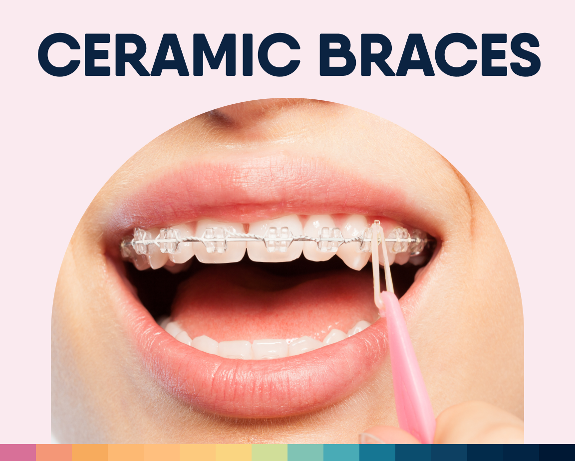 Open mouth with ceramic braces, text CERAMIC BRACES above.