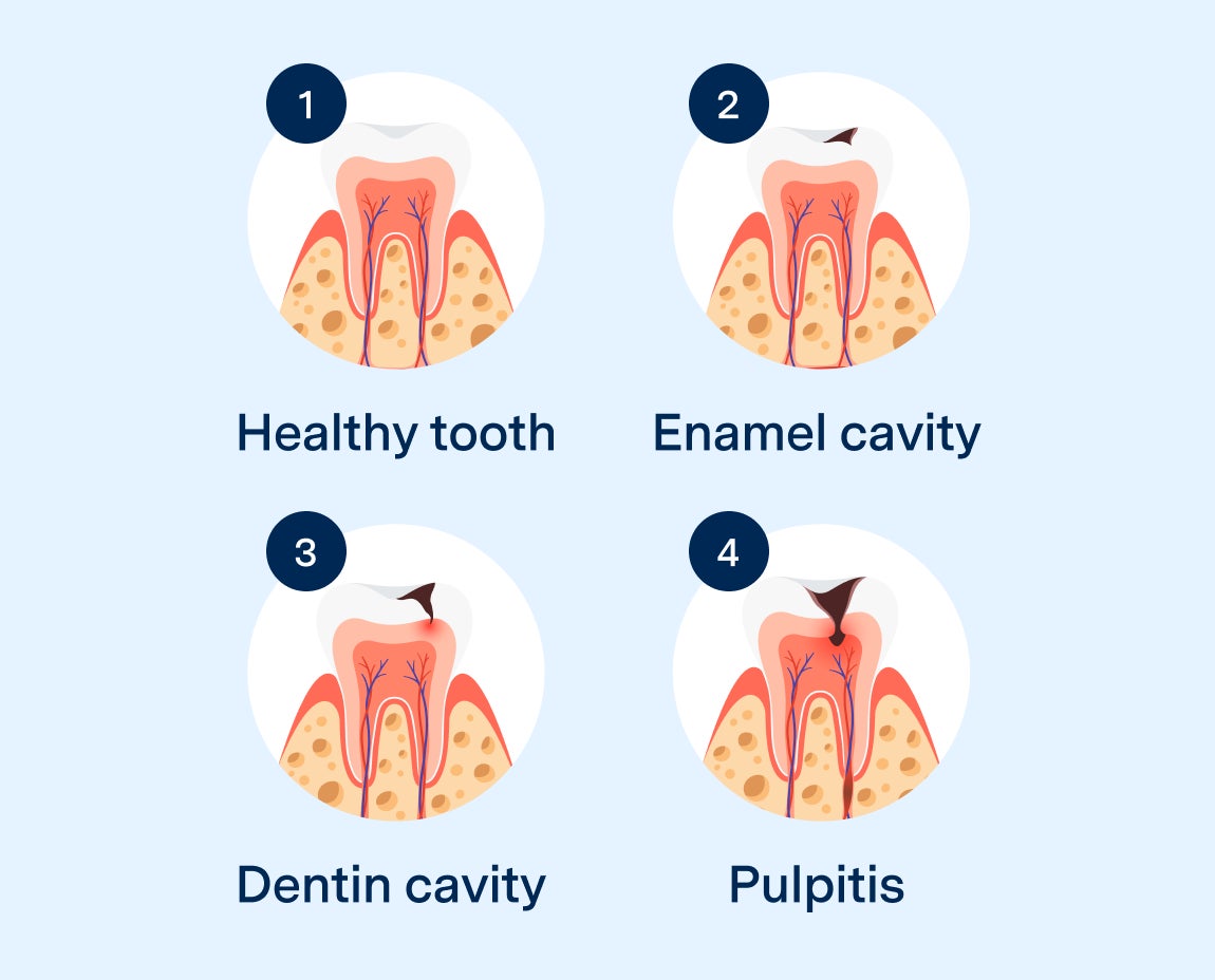 Diagram showing four stages of tooth health and decay progression: a healthy tooth, an enamel cavity, a dentin cavity, and pulpitis. Each stage illustrates the internal tooth structure and how decay advances deeper into the tooth layers.
