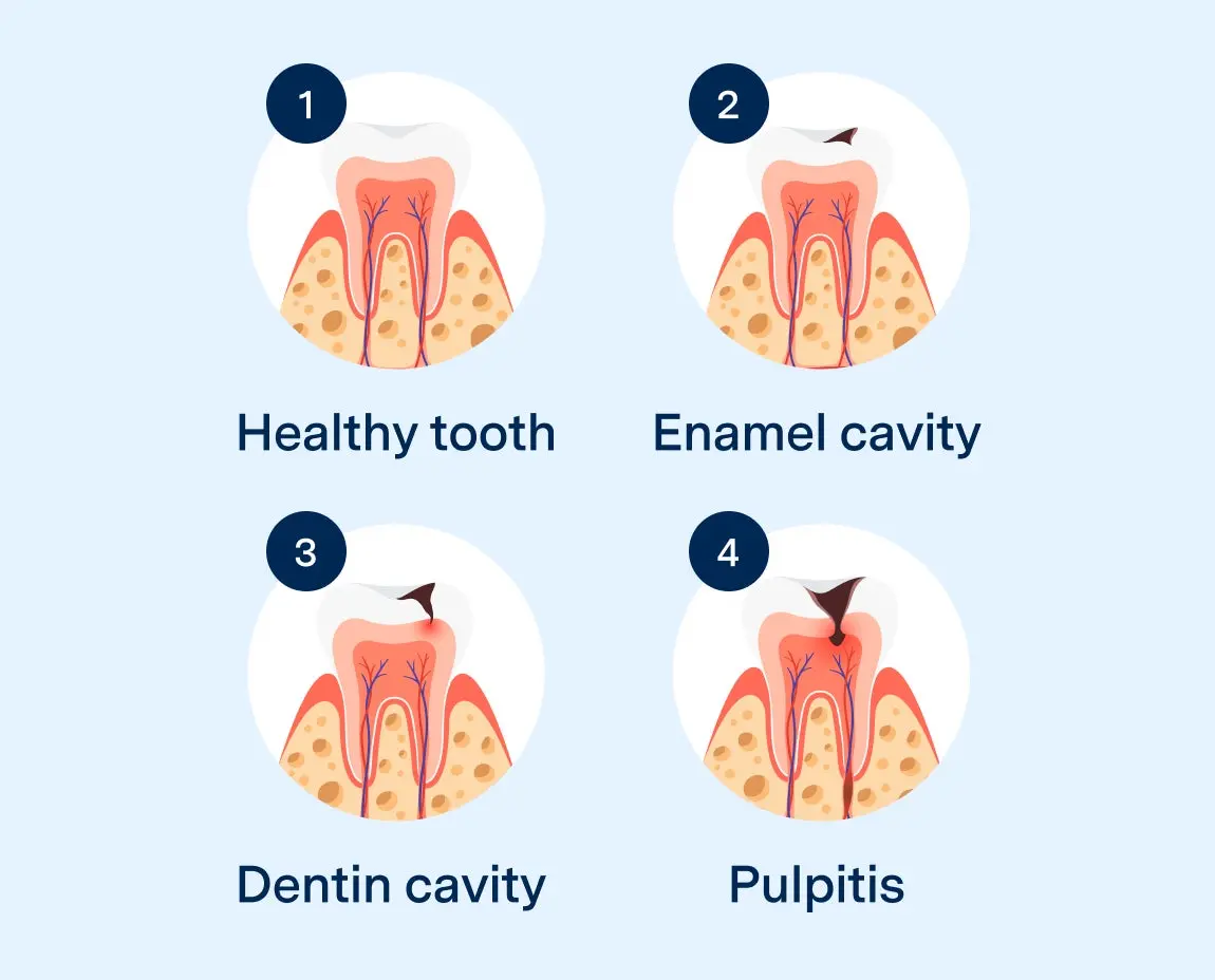 Diagram showing four stages of tooth health and decay progression: a healthy tooth, an enamel cavity, a dentin cavity, and pulpitis. Each stage illustrates the internal tooth structure and how decay advances deeper into the tooth layers.