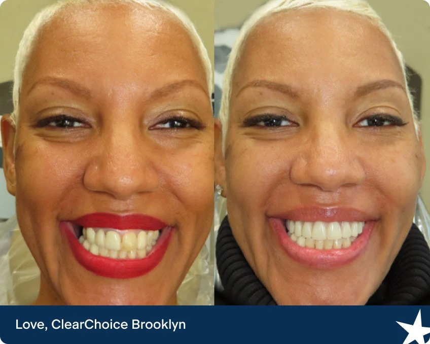 Full Mouth Dental Implants | ClearChoice