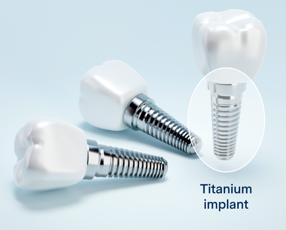 Several dental implants arranged neatly on a table, emphasizing their titanium material.