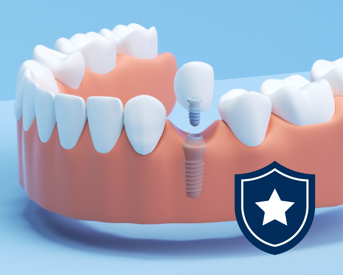 An illustration of a single dental implant being inserted into the lower jaw, with a star icon representing the warranty on implants.