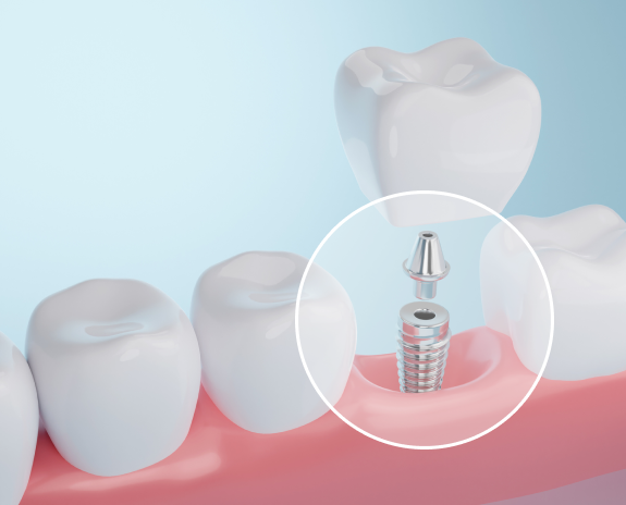 A dental implant being inserted into a gum model, demonstrating tooth implant procedure.