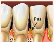  Aspen Dental Advanced Periodontitis Image