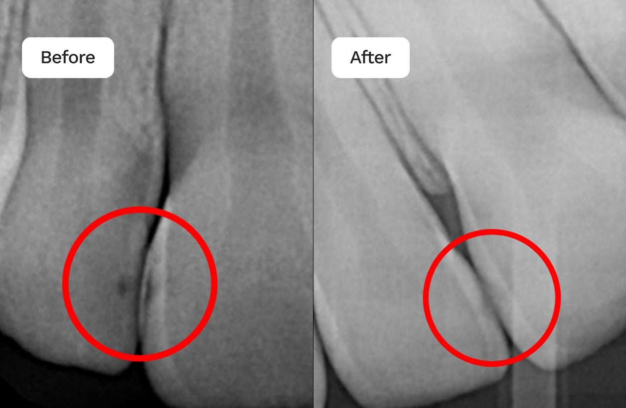 Before and after x-rays of a patient who received Curodont dental treatment. 