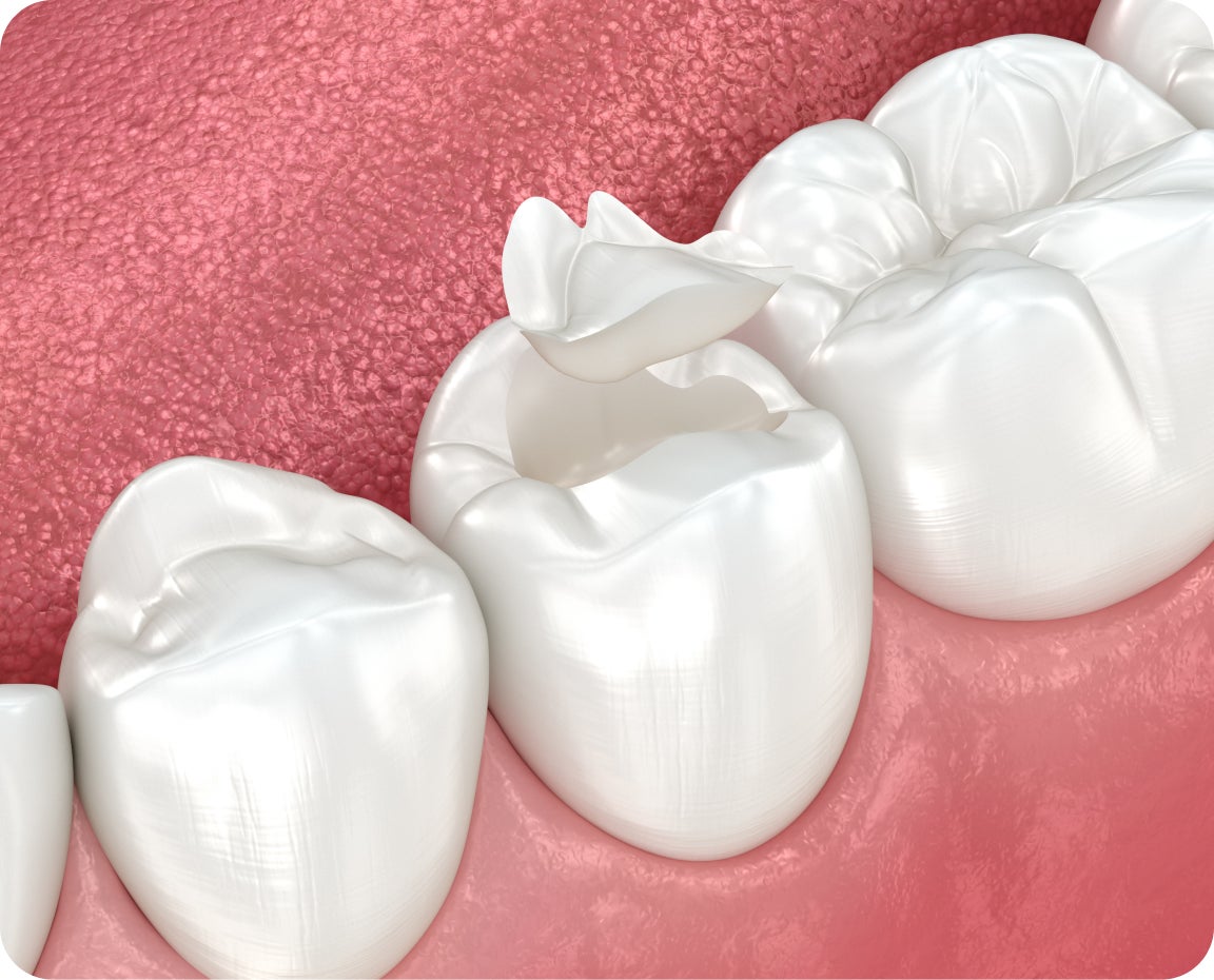 3D illustration shows a temporary tooth filling being placed on a molar. Depicts short-term tooth repair.