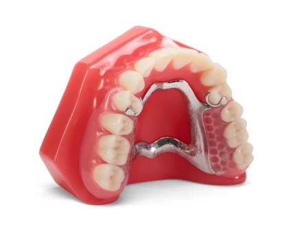 An upper denture model displaying Flexilytes Combo℠ partial dentures with a metal framework.