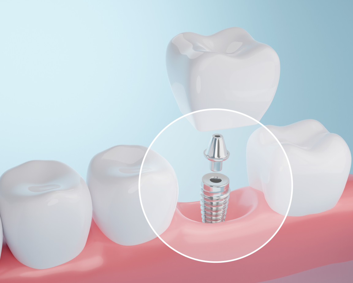 A close up visual of a dental implant, specifically highlighting the implant screw function in the jawbone.