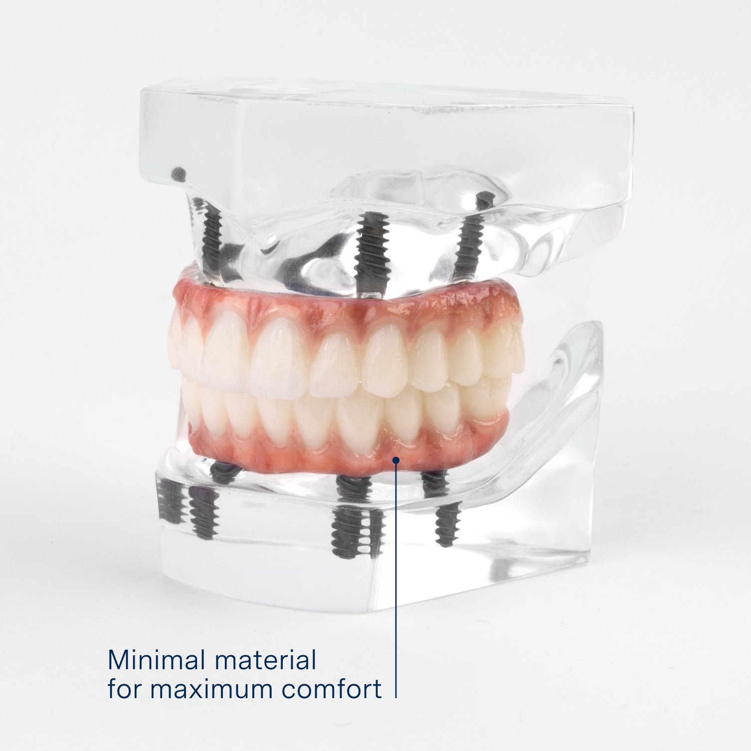 A clear acrylic model displaying a full-arch dental implant restoration with minimal material for maximum comfort. Designed for stability and a natural feel, this implant solution offers a secure and functional smile.
