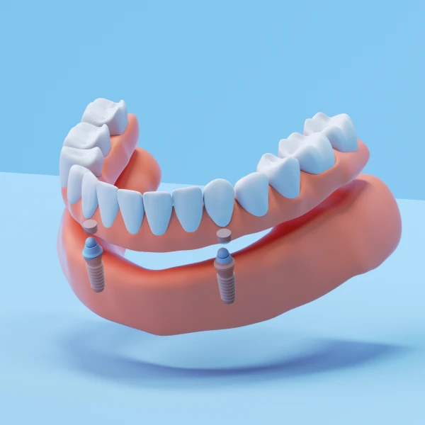 A 3D rendering of a full mouth dental implant. 