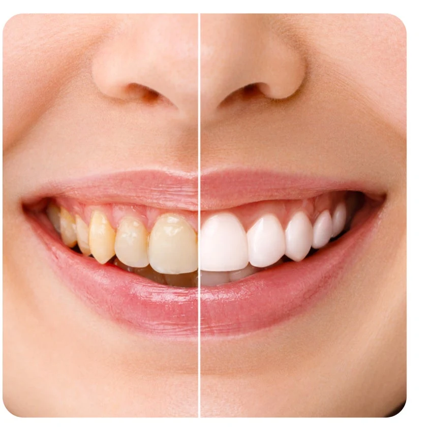 A close-up image of a mouth showing a comparison of teeth before and after whitening. The left side displays yellowed teeth, and the right side displays gleaming white teeth.