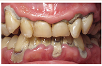 Aspen Dental Advanced Periodontitis Image