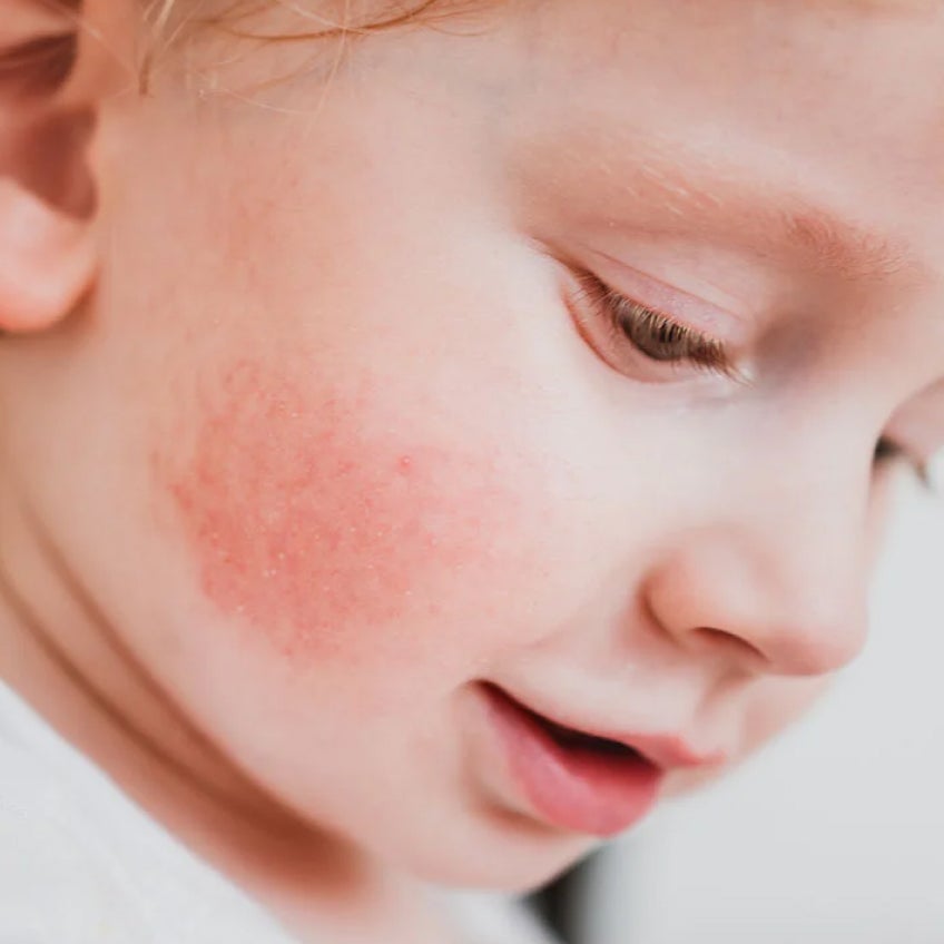 A close up of a baby 's face with red cheeks