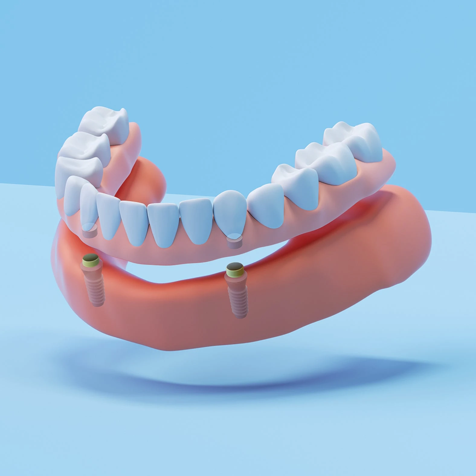Affordable Snap In Dentures Cost & Options | Aspen Dental