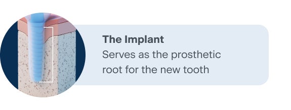 Illustration of a dental implant showing the prosthetic root that supports a new tooth for ClearChoice.