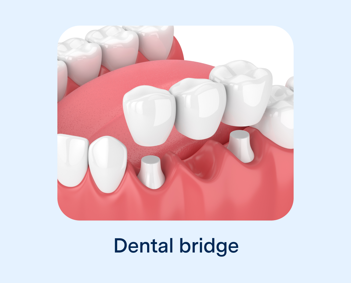 Graphic of a dental bridge - a dental prosthesis used to replace missing teeth on light blue background with words 'dental bridge'