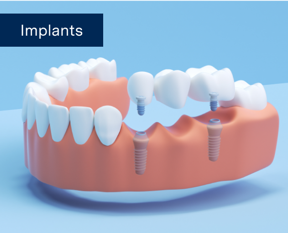 A graphic of dental implant bridge providing a permanent solution for a missing tooth on a blue background with the words 'Implants' written on the image.