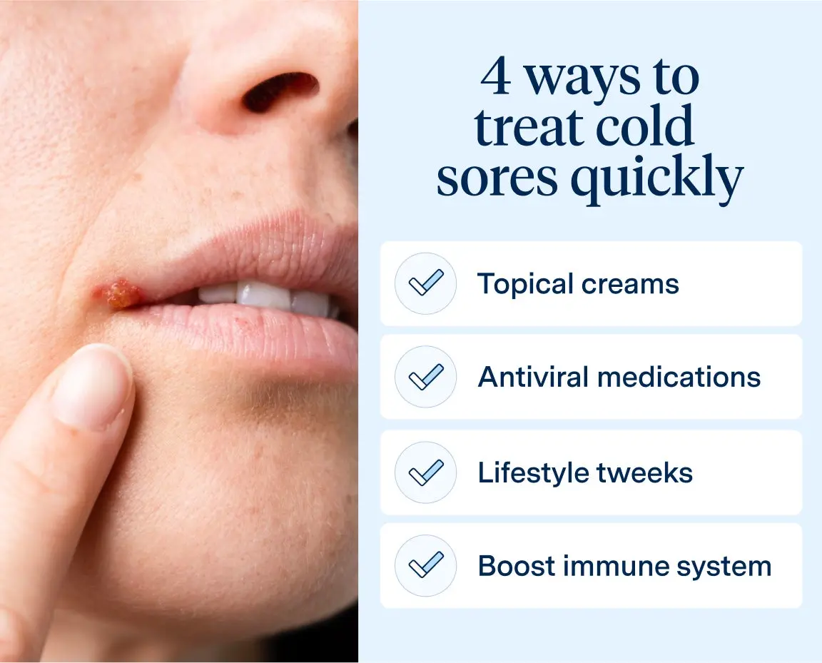 Infographic showing four ways to treat cold sores quickly, including topical creams and antiviral medications. Supports fast relief guidance for how to get rid of a cold sore quickly.