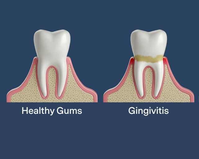 Healthy gums vs gingivitis