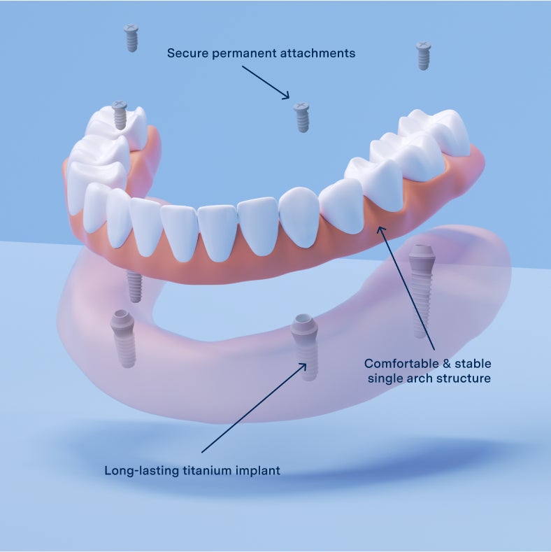 Aspen Dental implant dentures diagram. 