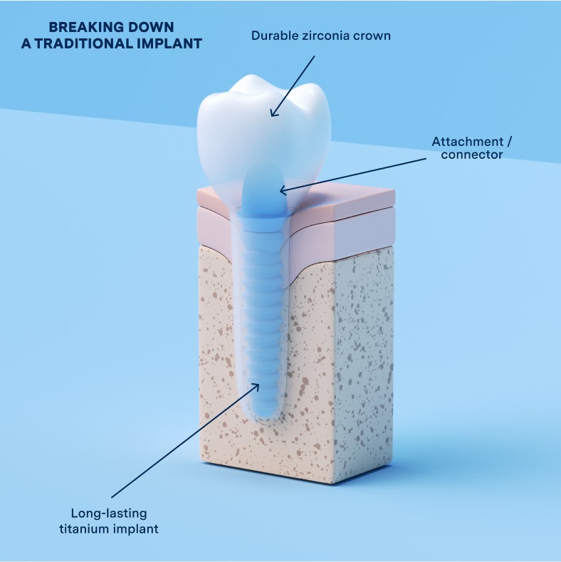 Aspen Dental implant denture cross-sectional diagram. 