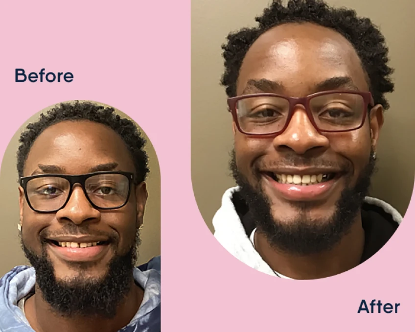 Before and after comparison photos of a man's smile transformation with Motto.