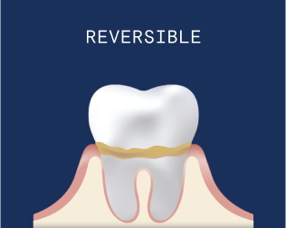 Gingivitis with Receding Gums: The symptoms are swelling, redness, and bleeding gums. No damage to bone or connective tissue.