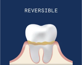 Gingivitis with Receding Gums: The symptoms are swelling, redness, and bleeding gums. No damage to bone or connective tissue.