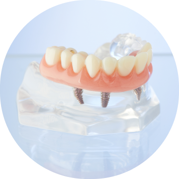 Aspen Dental fixed full mouth dental implants