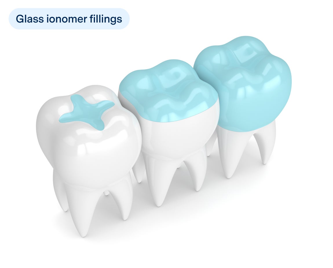 Illustration of three teeth with glass ionomer fillings, showing the material in a blue color.