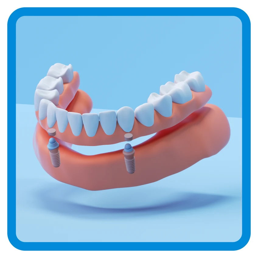Un gráfico que muestra una dentadura postiza con implantes para toda la fila inferior de dientes.