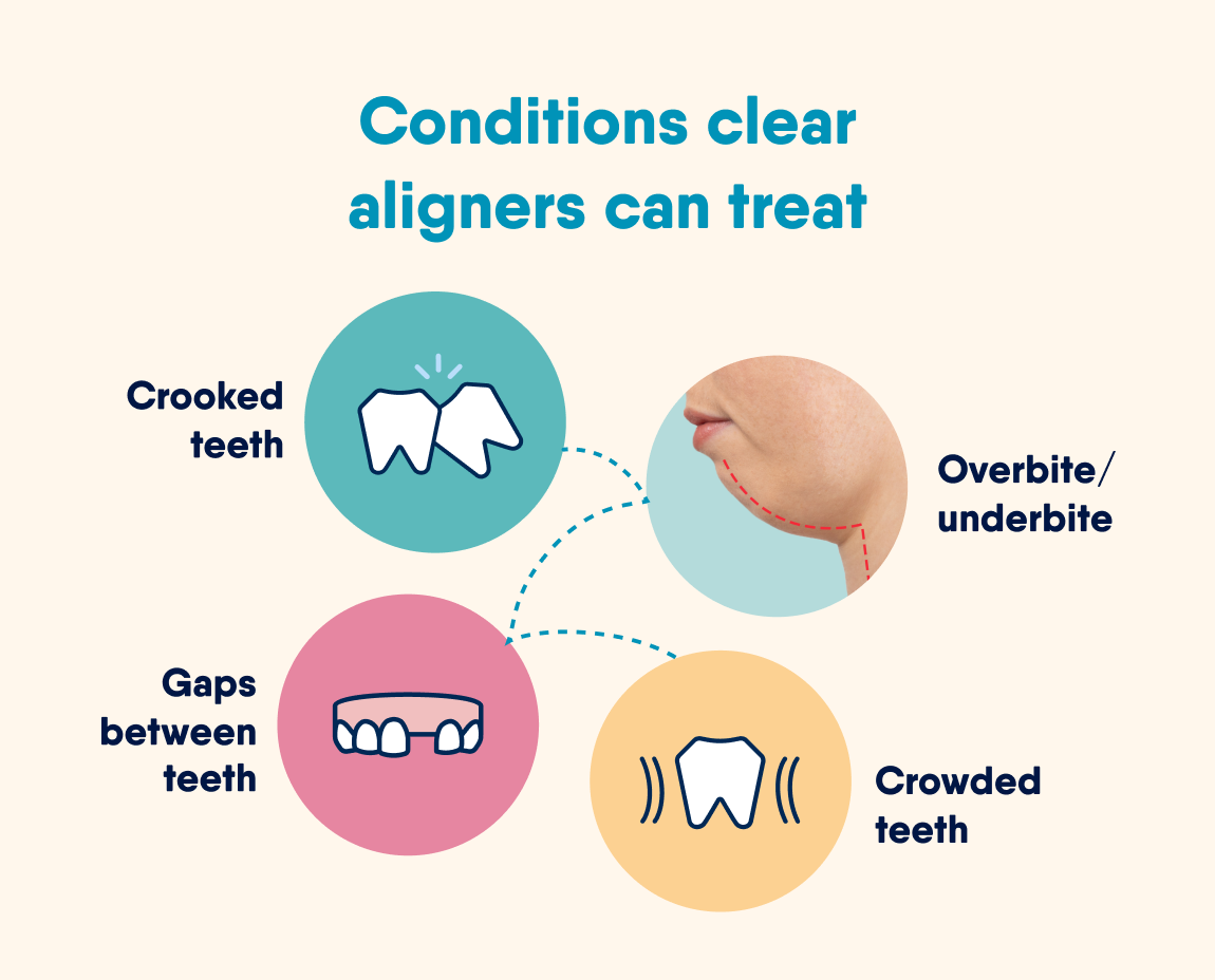 Illustration of different types of conditions clear aligners can treat: 
crooked teeth
crowded teeth
gaps between teeth, and 
mild to moderate bite issues.