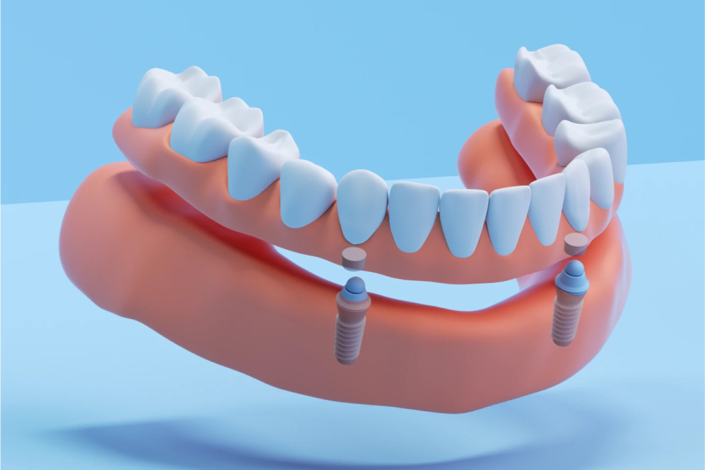 An illustration of Implant dentures. The implant dentures are removeable premium snap-in denture, with the secure fit of permanent titanium implants, designed for a comfortable, stable fit with no adhesives.