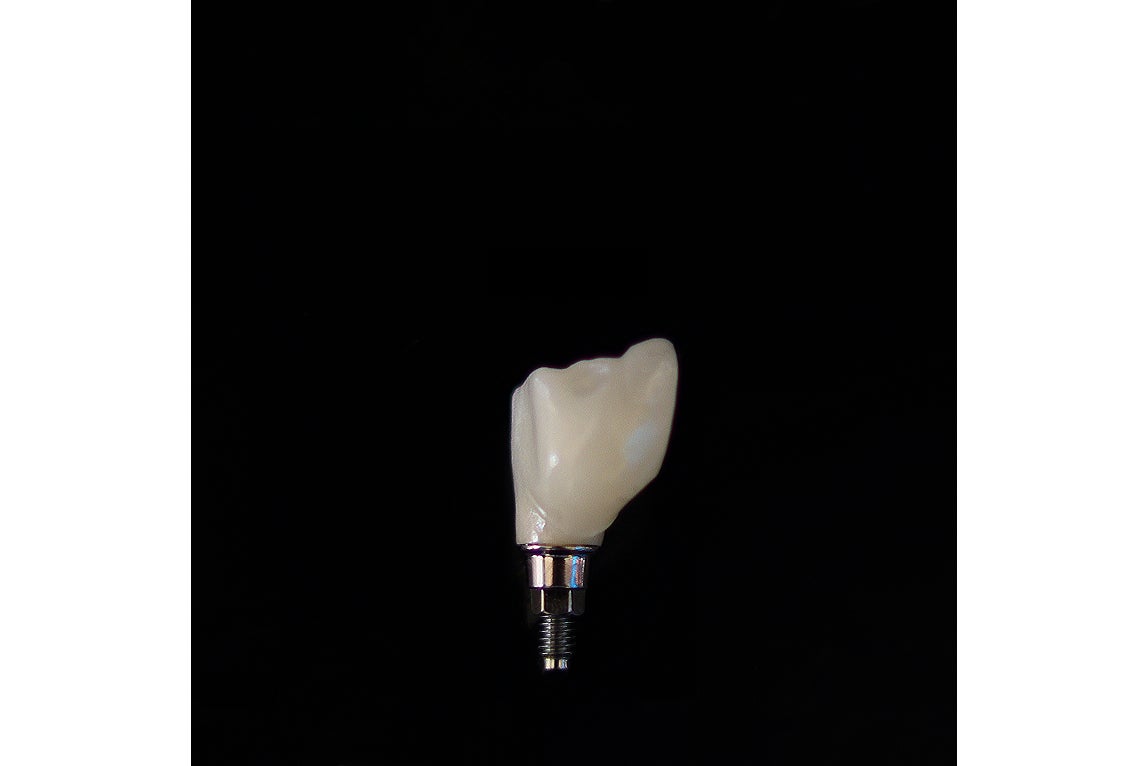 Close-up of a screwless dental implant crown attached to an implant post, demonstrating a cement-retained, natural-looking implant restoration.