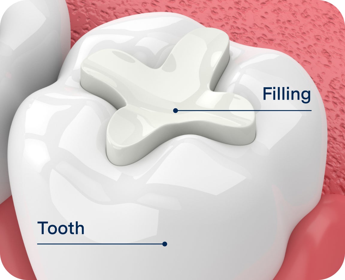Close-up of a white tooth model showing a composite filling material applied to the chewing surface, demonstrating how tooth-colored fillings restore damaged enamel.