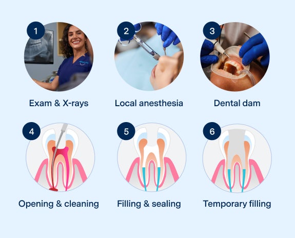 Illustration of the six steps involved in a root canal procedure at Aspen Dental, including exam, anesthesia, dental dam, opening, cleaning, filling, and sealing.