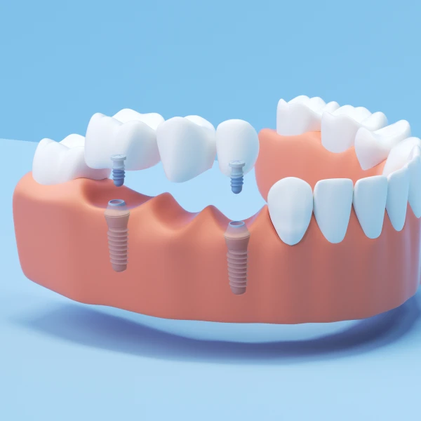 A 3D rendering of an implant-supported bridge.