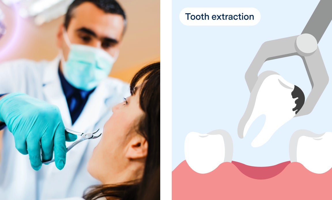 Two images side by side. Left image: A dentist in protective gear carefully performing a tooth extraction on a patient, illustrating the professional and precise dental care provided by Aspen Dental. Right image: An illustration showing the process of tooth extraction with dental tools, representing the detailed and effective tooth extraction services available at Aspen Dental.