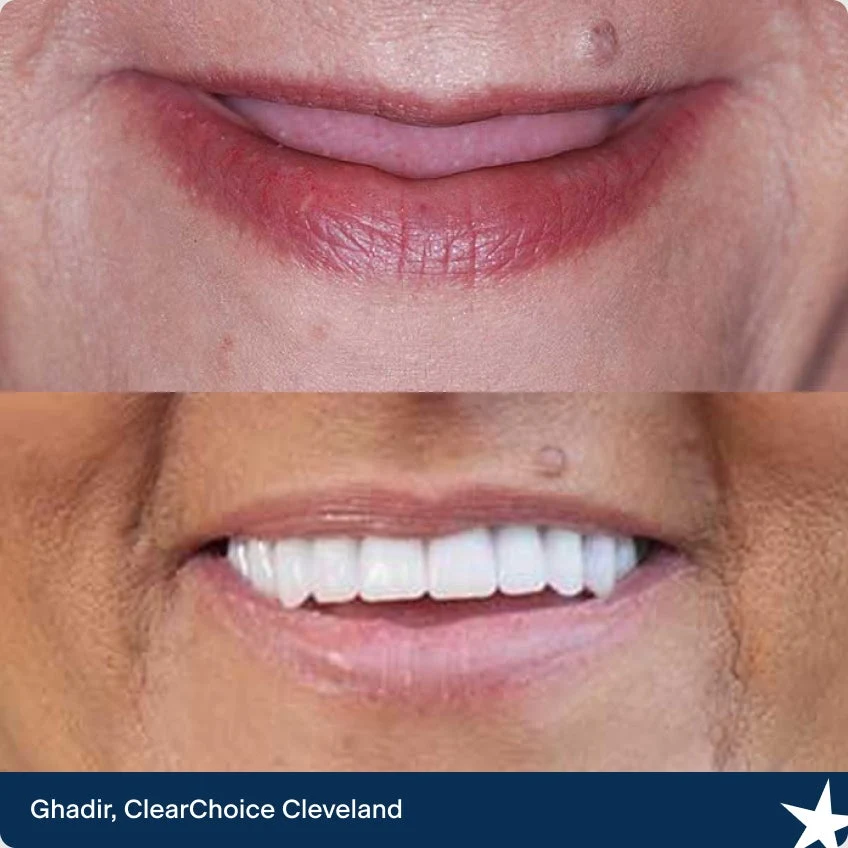 The before and after dental implant images of Ghadir. Our ClearChoice patient from Cleveland.