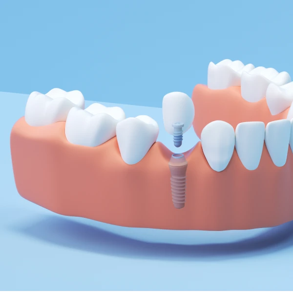 A 3D rendering of a single tooth implant.