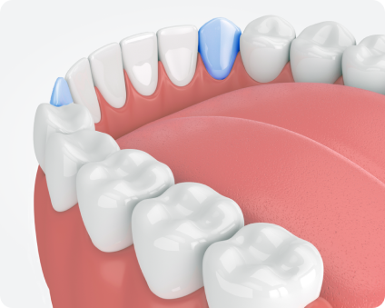 3D illustration of an anterior root canal procedure, focusing on the front teeth, commonly performed on canines and incisors.