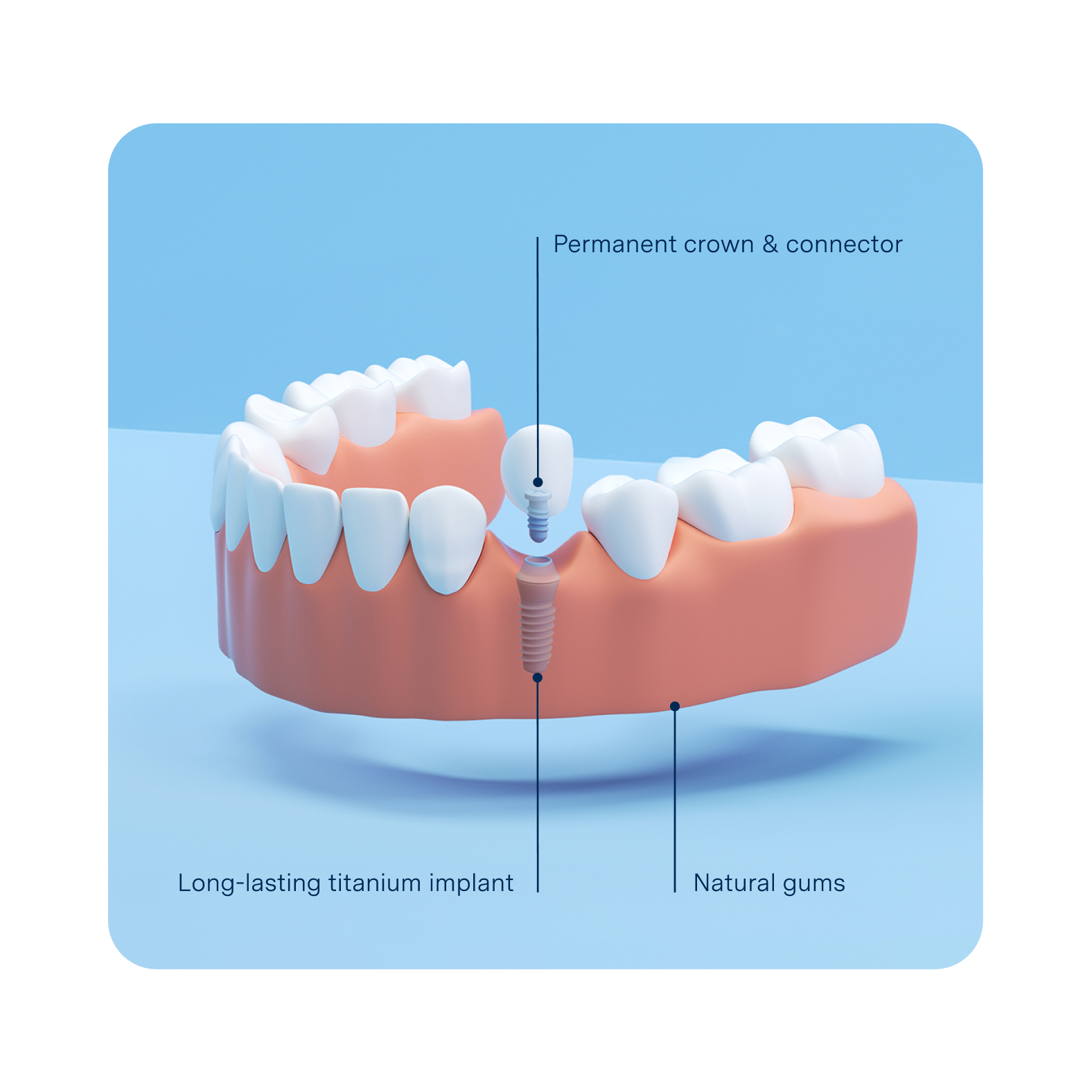 Dental Implant Process at Aspen Dental.